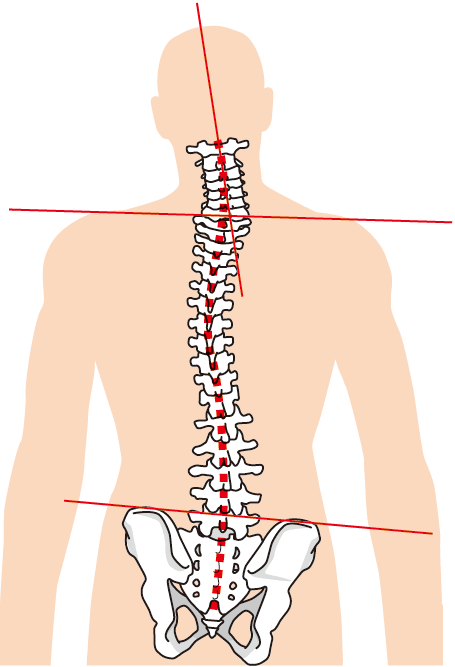 脊椎が歪むと骨盤が歪む図