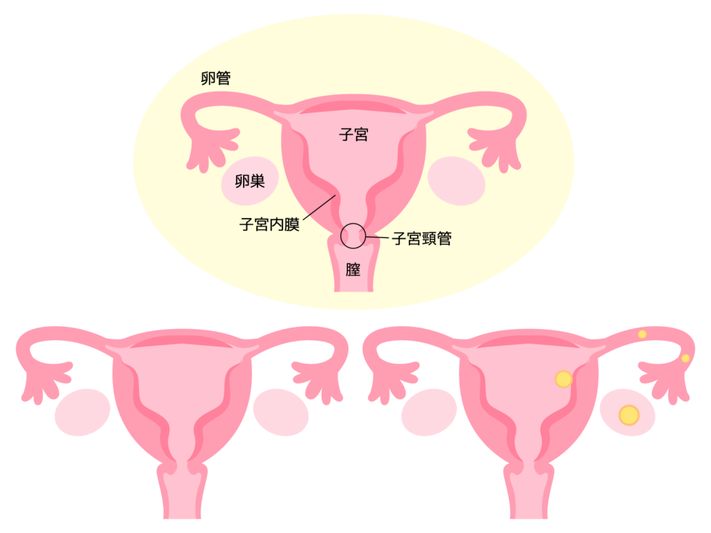エストロゲンの働きで、子宮内膜が厚くなり受精卵の着床準備をし 子宮内膜が厚くなると下垂体からFSH（卵胞刺激LH（黄体形成性腺の刺激ホルモンが放出される
